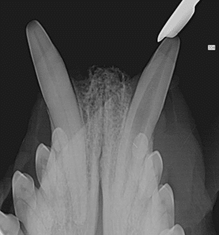 Wortelkanaalbehandeling
